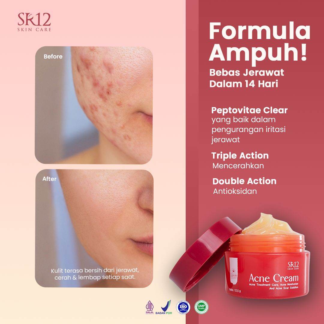 Acne Series_SR12 (Acne Cream / Acne Totol / Acne Toner / Toner BHA) Bebas Jerawat dalam 14 Hari Kempes Mencerahkan Antioksidan